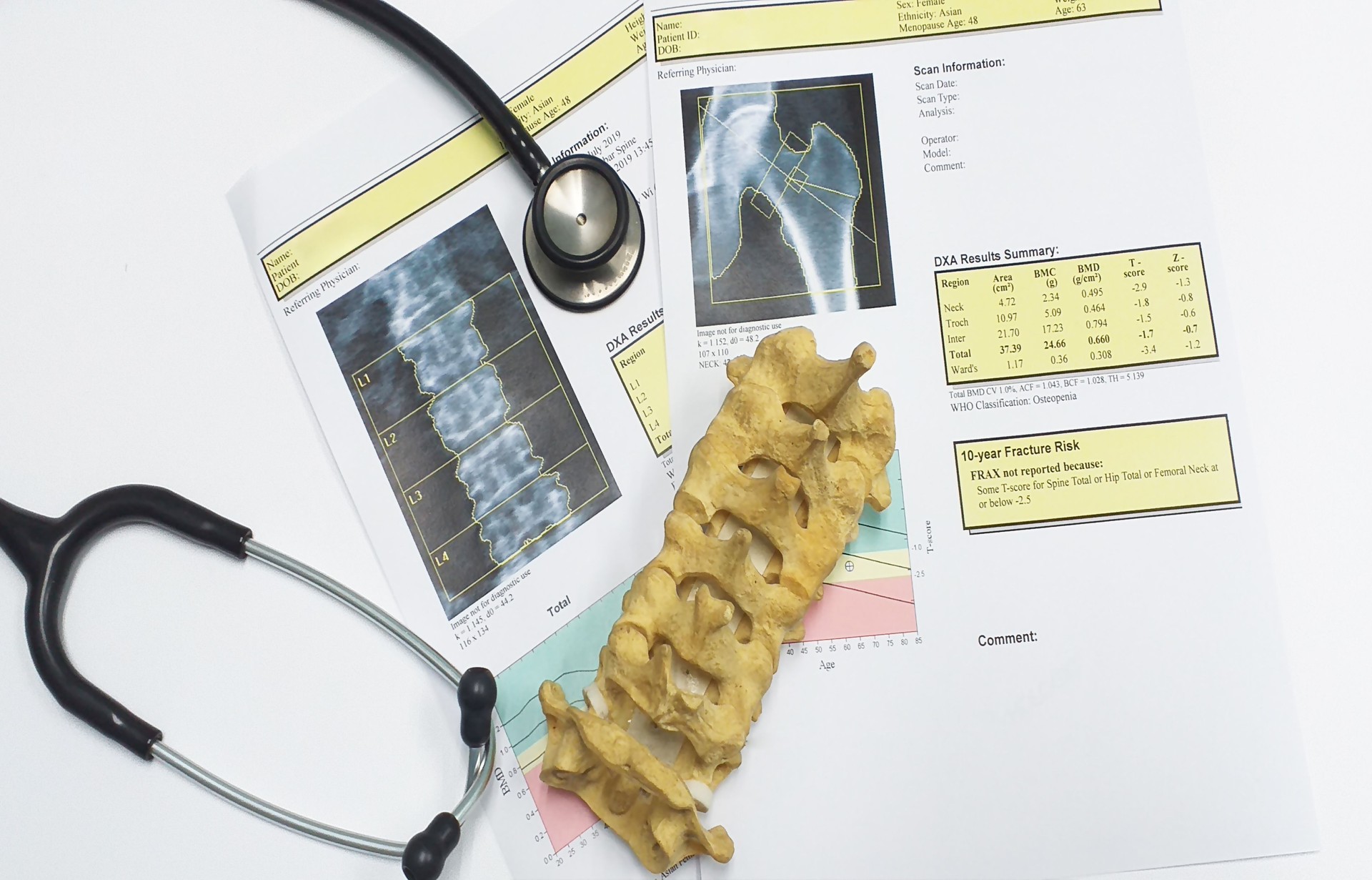 bone density hip and lumbarspine Result Osteoporosis